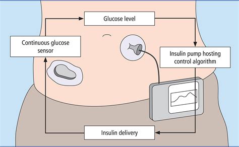 A Closed Loop System For Insulin Delivery Contains: