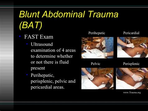 A Rapid Irregular Pulse Following Blunt Trauma