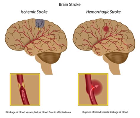 A Stroke Is Also Known As Quizlet