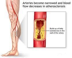 Applied To An Extremity To Impair The Circulation