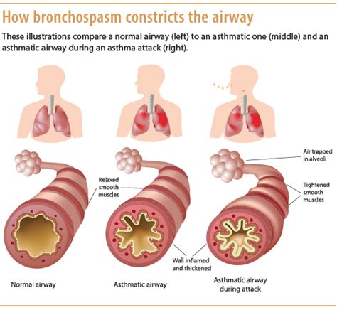 Bronchial Airway Obstruction Marked By Paroxysmal Dyspnea Wheezing And Cough