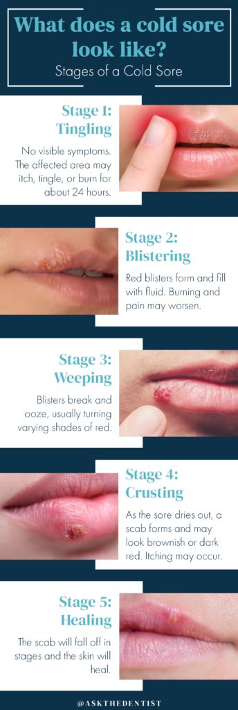 Cold Sore Recurrence Can Be Triggered By Quizlet