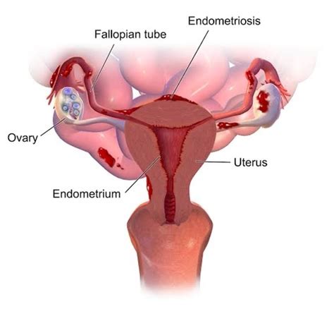 Endometriosis Is A Condition In Which Quizlet