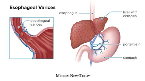 Esophageal Varices Most Commonly Occur In Patients Who Quizlet