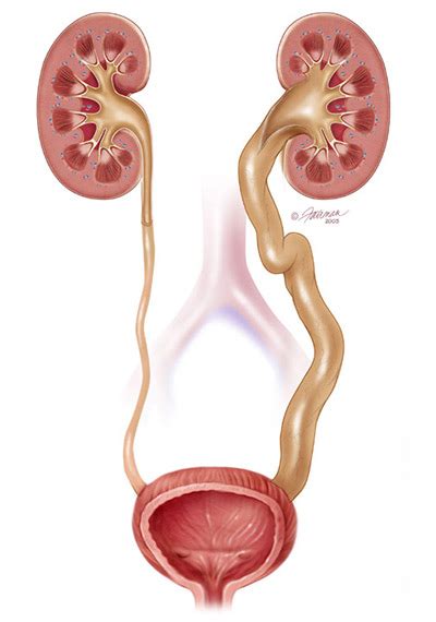 Hernia Of The Tube Connecting The Kidney And Urinary Bladder