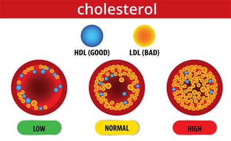 High Levels Of Cholesterol Can First Lead Directly To __________.