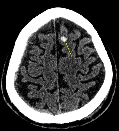 In Contrast To A Cerebral Concussion A Cerebral Contusion