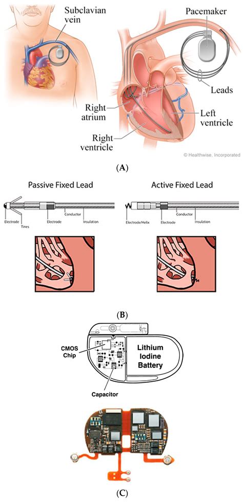 In Contrast To An Automated Implanted Cardioverter