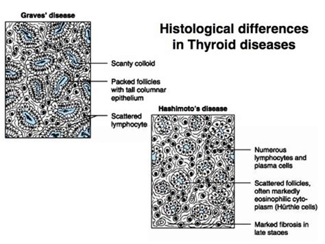 It Is True That Graves Disease Is Quizlet