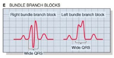 Left Bundle Branch Block Is Characterized By Quizlet