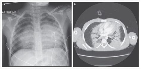 Signs Of A Pulmonary Blast Injury Include