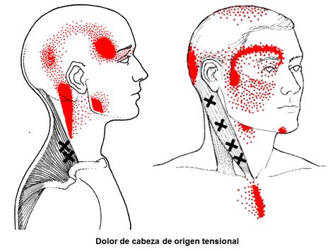 Tengo Dolor De Cabeza Y Fiebre Quizlet