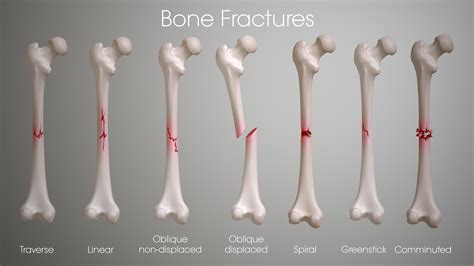 The Most Reliable Indicator Of An Underlying Fracture Is