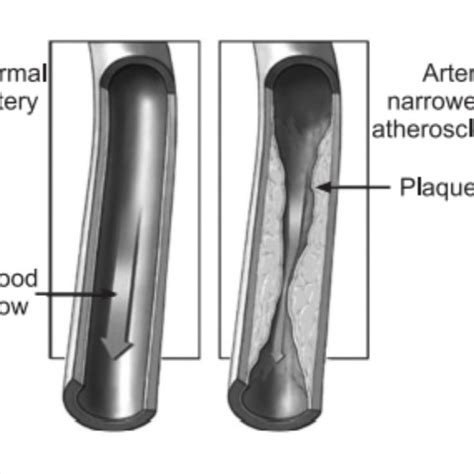 The Term Multiple Sclerosis And Atherosclerosis Both Refer To