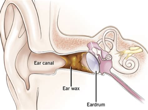 What Does Research Show About Hearing Loss Quizlet