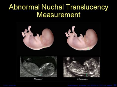 What Is The Main Goal Of Prenatal Screening Quizlet