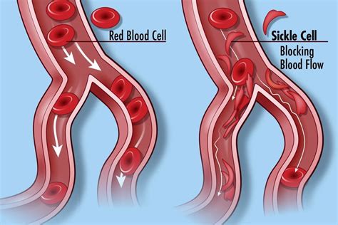 What Is The Underlying Cause Of Sickle Cell Disease Quizlet