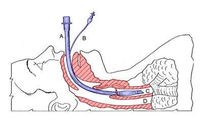 Whem An Advanced Airway Is In Place