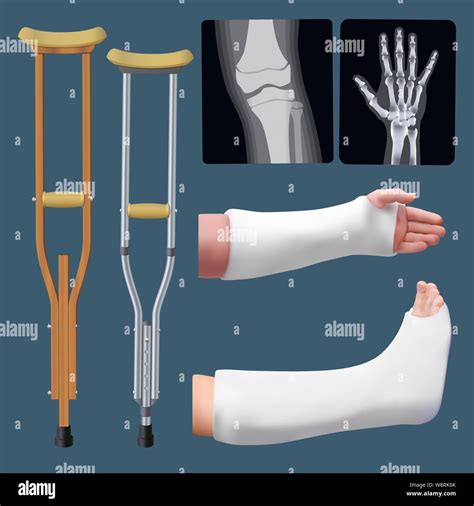 Where Is A Splint Attached To Stabilize A Broken Bone