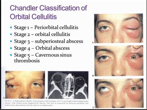 Which Clinical Manifestation Is Associated With Cellulitis Quizlet