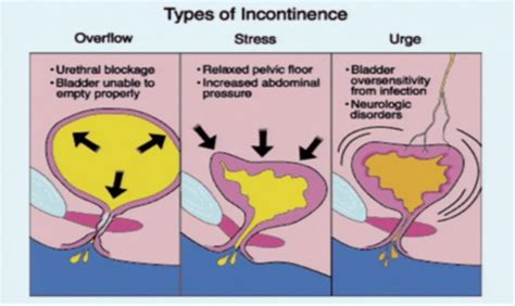 Which Condition Is A Cause Of Transient Urinary Incontinence Quizlet