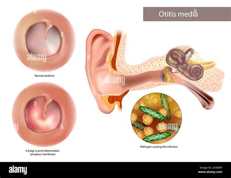 Which Condition Is A Contagious Inflammation Of The Eardrum