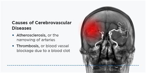 Which Is A Cerebrovascular Manifestation Of Heart Failure