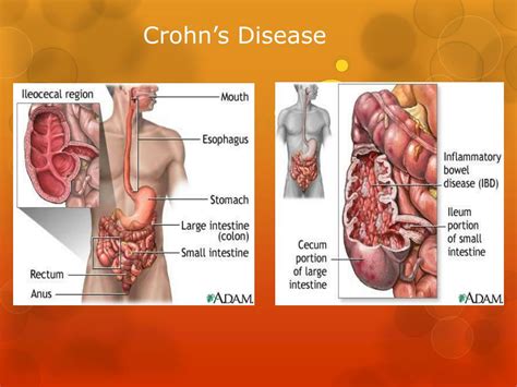 Which Is A True Statement Regarding Regional Enteritis Crohn's Disease