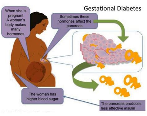 Which Statement Is True Regarding Gestational Diabetes