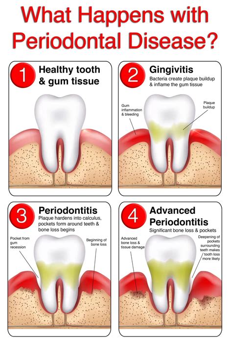 Which Symptoms Do Not Identify Early Signs Of Periodontal Disease