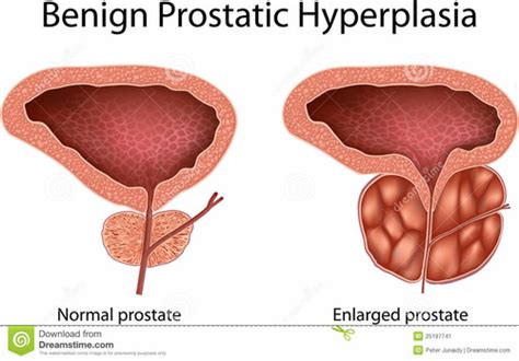 Why Would An Enlarged Prostate Interfere With Urination Quizlet